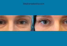 Пластика век: вопросы и ответы https://www.youtube.com/watch?v=myxng7SGjmk