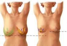 Маммопластика. Мифы и реалии. Маммопластика. Мифы и реалии.